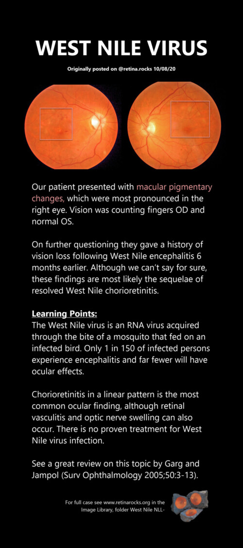 Infectious Disorders West Nile Virus Retina Rocks