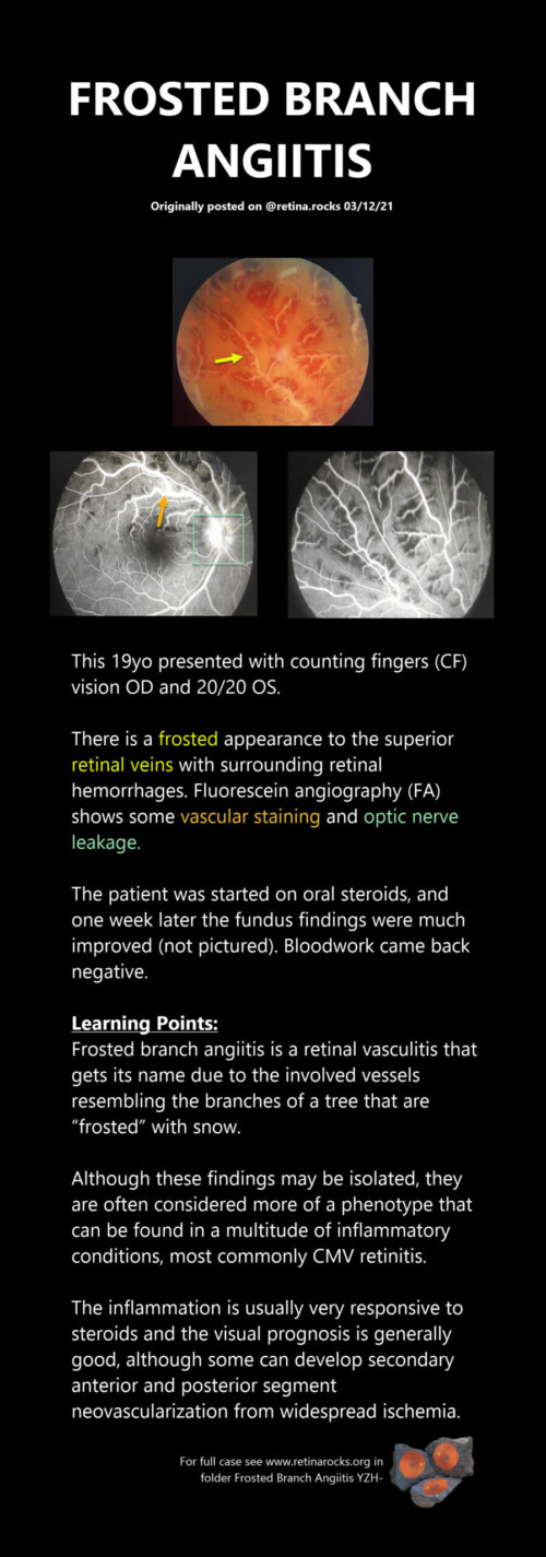 Inflammatory Disorders Frosted Branch Angiitis Retina Rocks