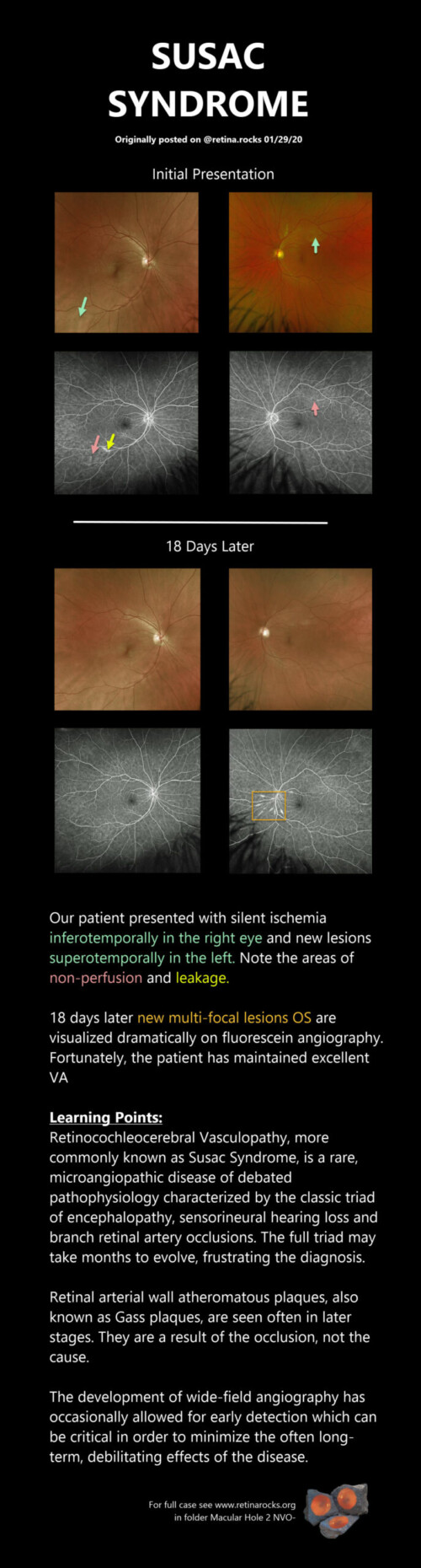 Retinal Vascular Disorders: Misc > Susac Syndrome - Retina Rocks