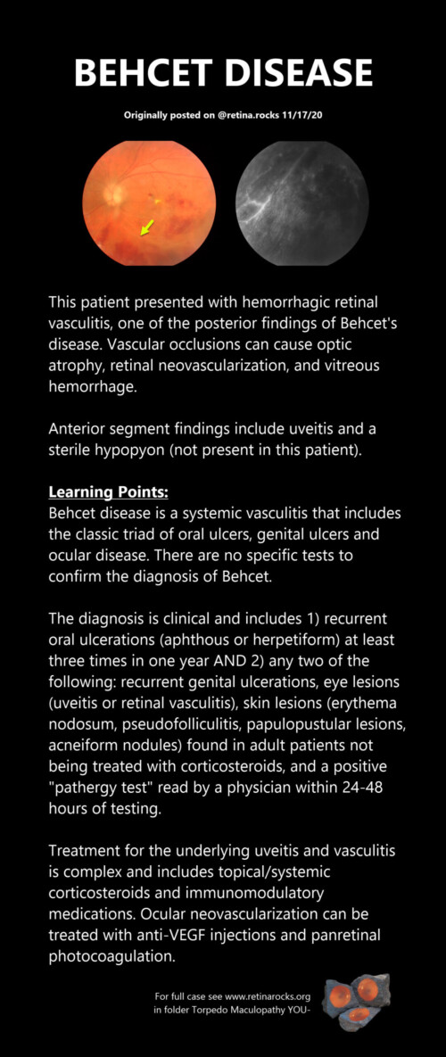 Inflammatory Disorders > Behcet Disease - Retina Rocks