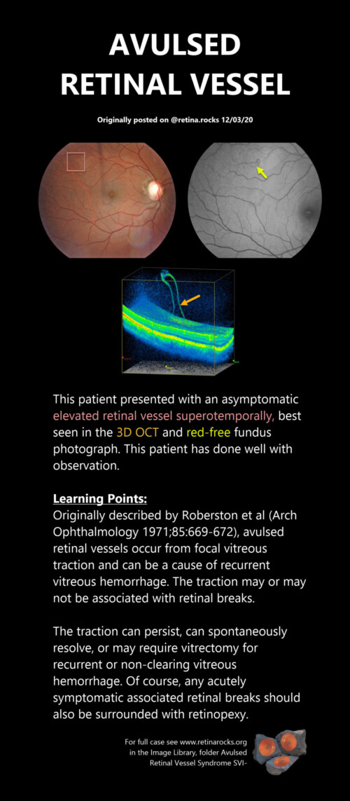 Vitreous, Vitreoretinal Interface Abnormalities, and Peripheral Retina ...