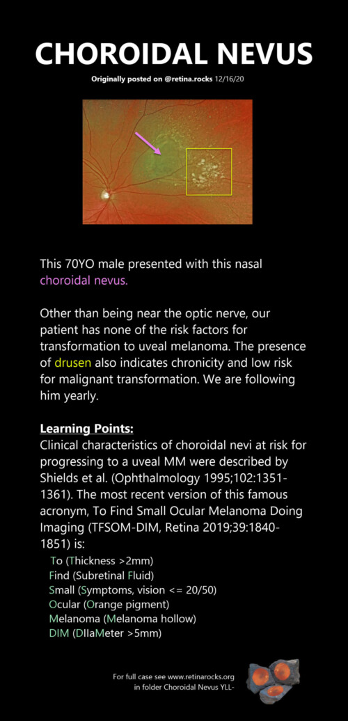 Neoplastic Choroid Disorders Choroidal Nevus And Freckle Retina Rocks