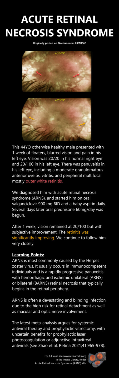 Infectious Disorders Acute Retinal Necrosis Arn Retina Rocks