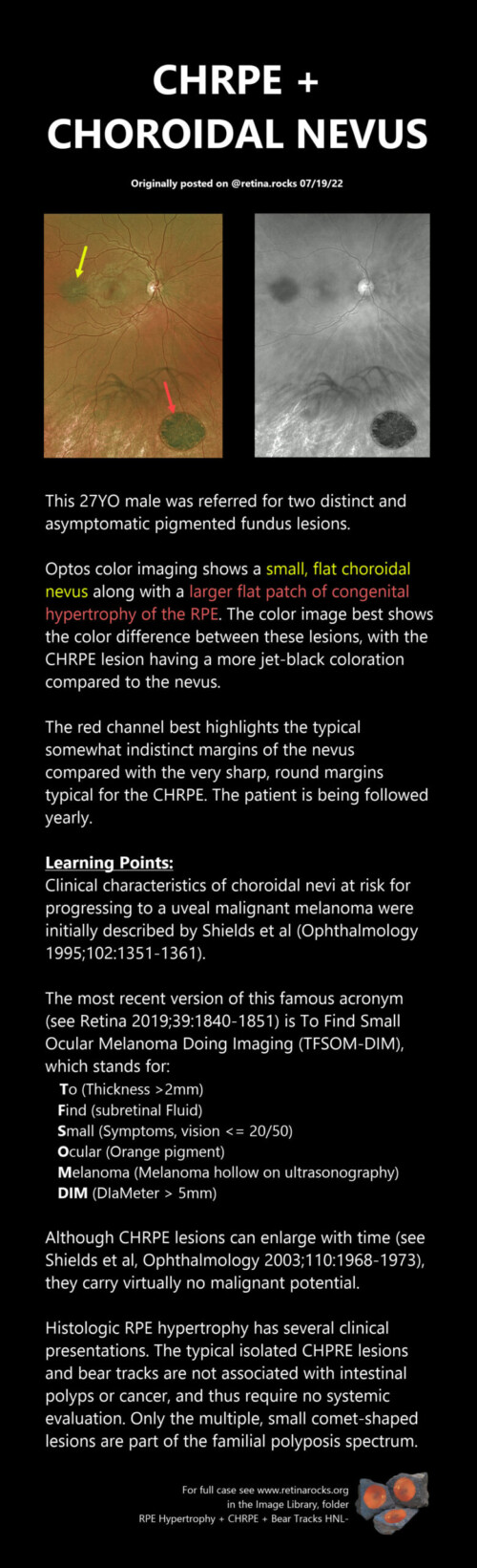 Neoplastic Choroid Disorders Choroidal Nevus And Freckle Retina Rocks