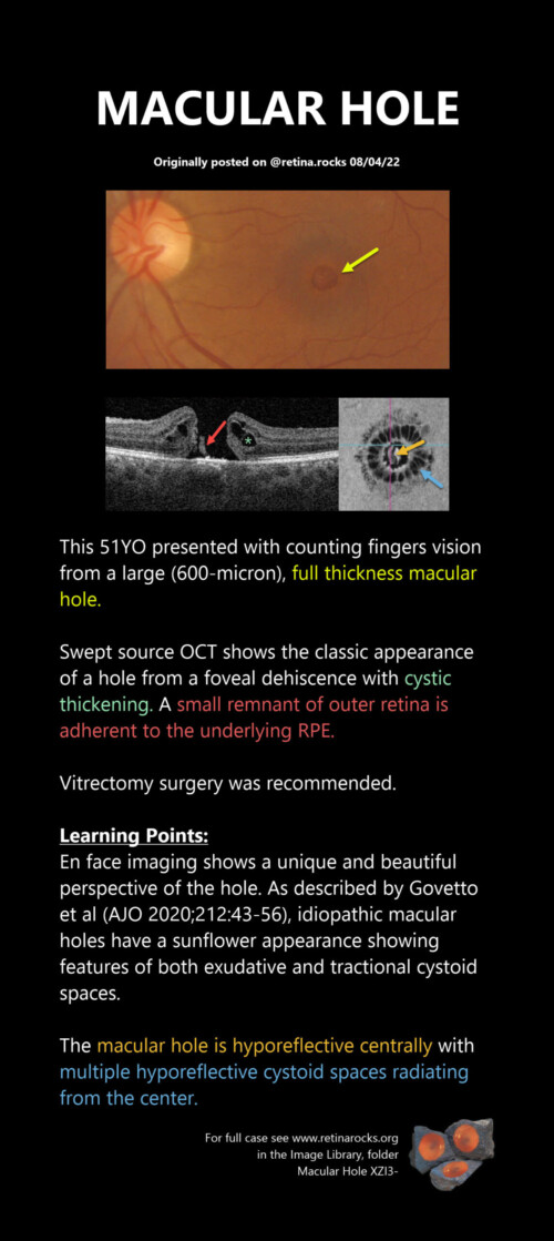 Vitreous, Vitreoretinal Interface Abnormalities, and Peripheral Retina ...